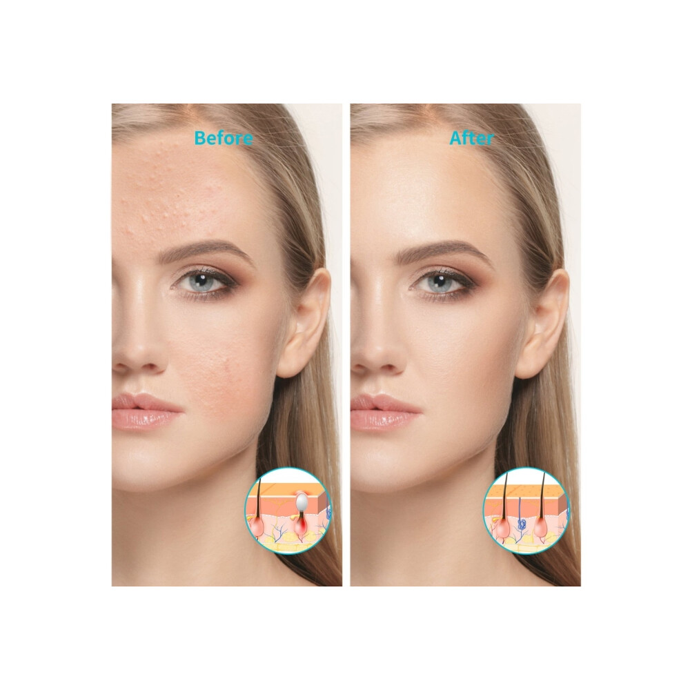 Xpreen trådløs genopladelig let acnebehandlingsenhed